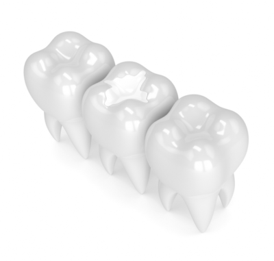 White Fillings - Cygnet House Dental