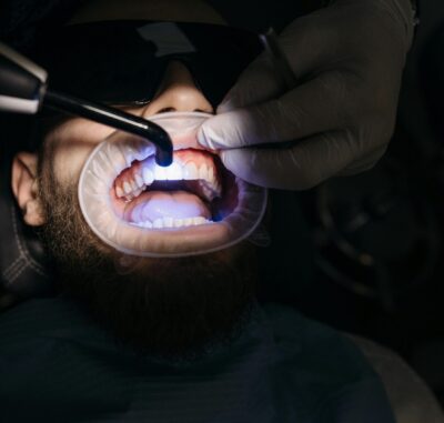 Tooth Coloured Fillings - Cygnet House Dental